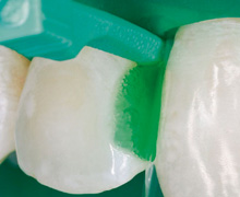 Mikroinvasive Kariesbehandlung Zahnärzte in der Wasserburg